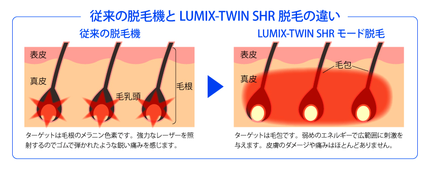従来の脱毛機とLUMIX-TWIN SRH脱毛の違い
